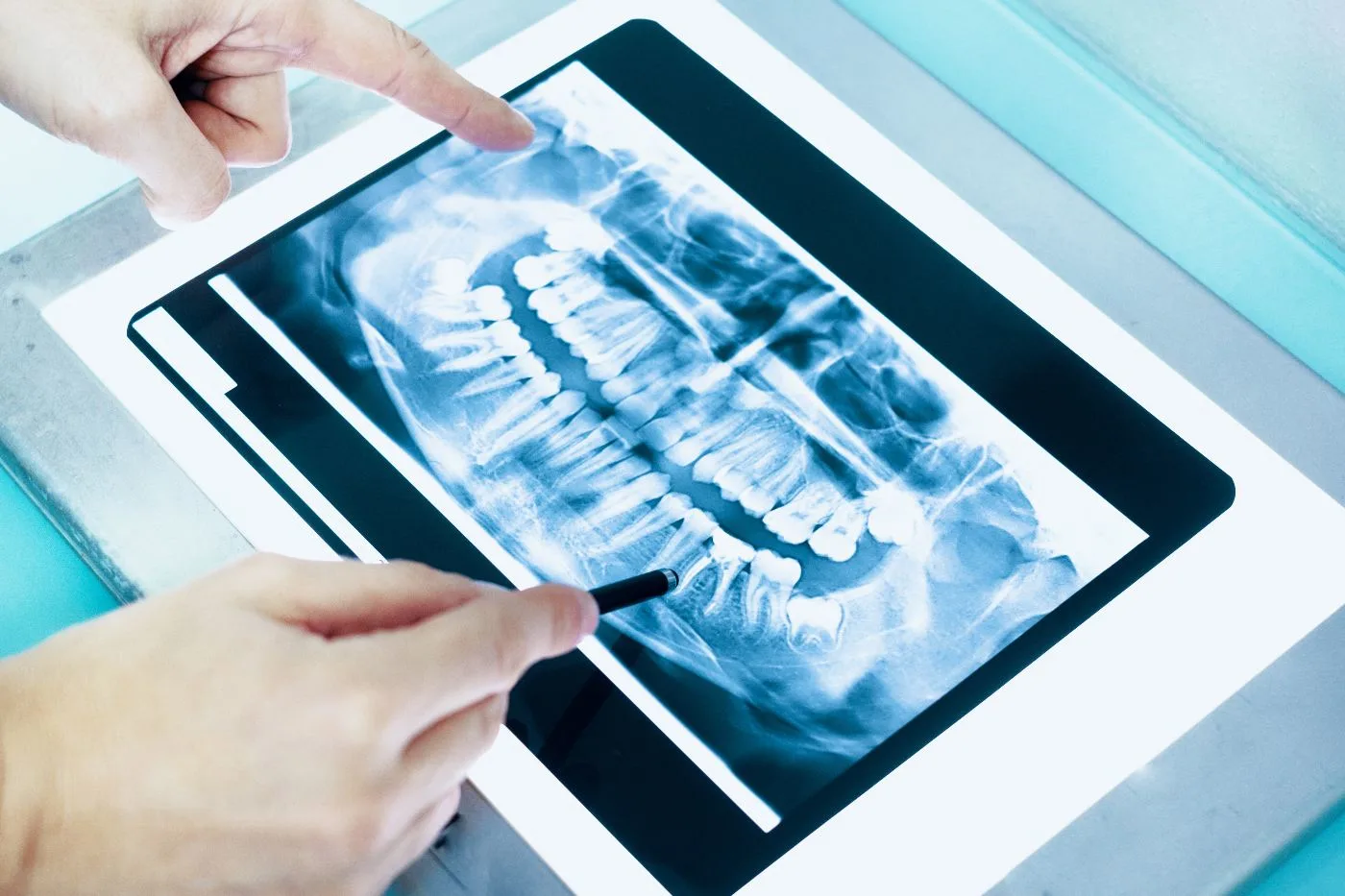 tooth extractions in conover