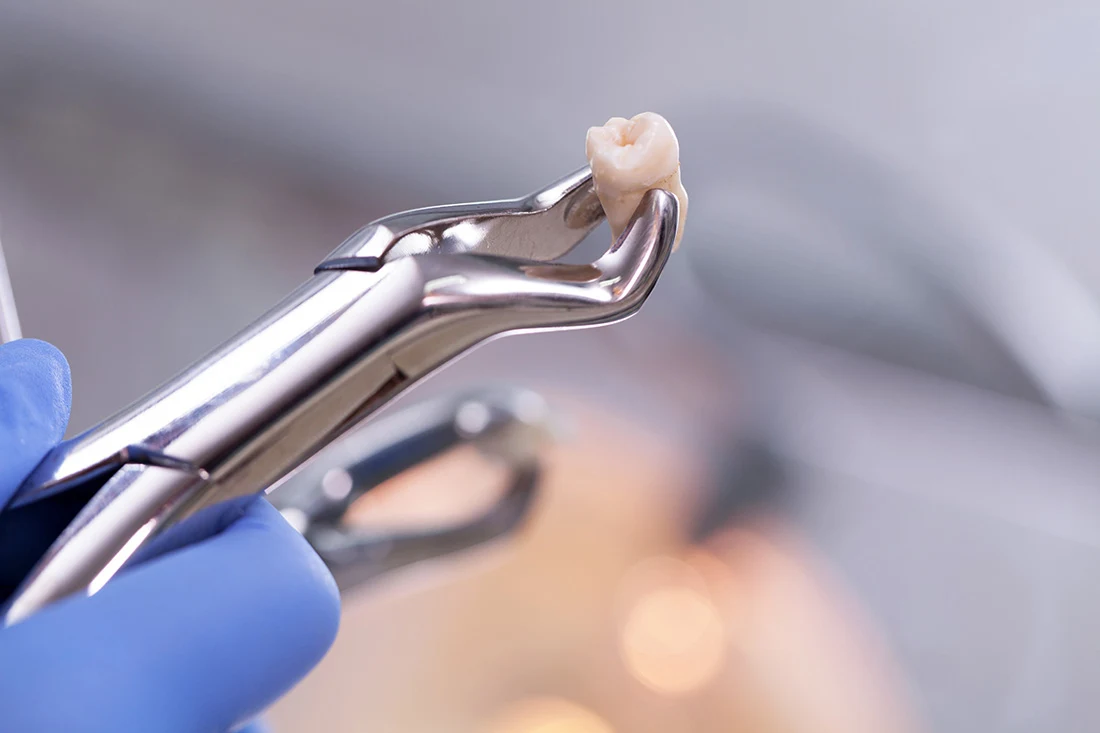 conover tooth extractions