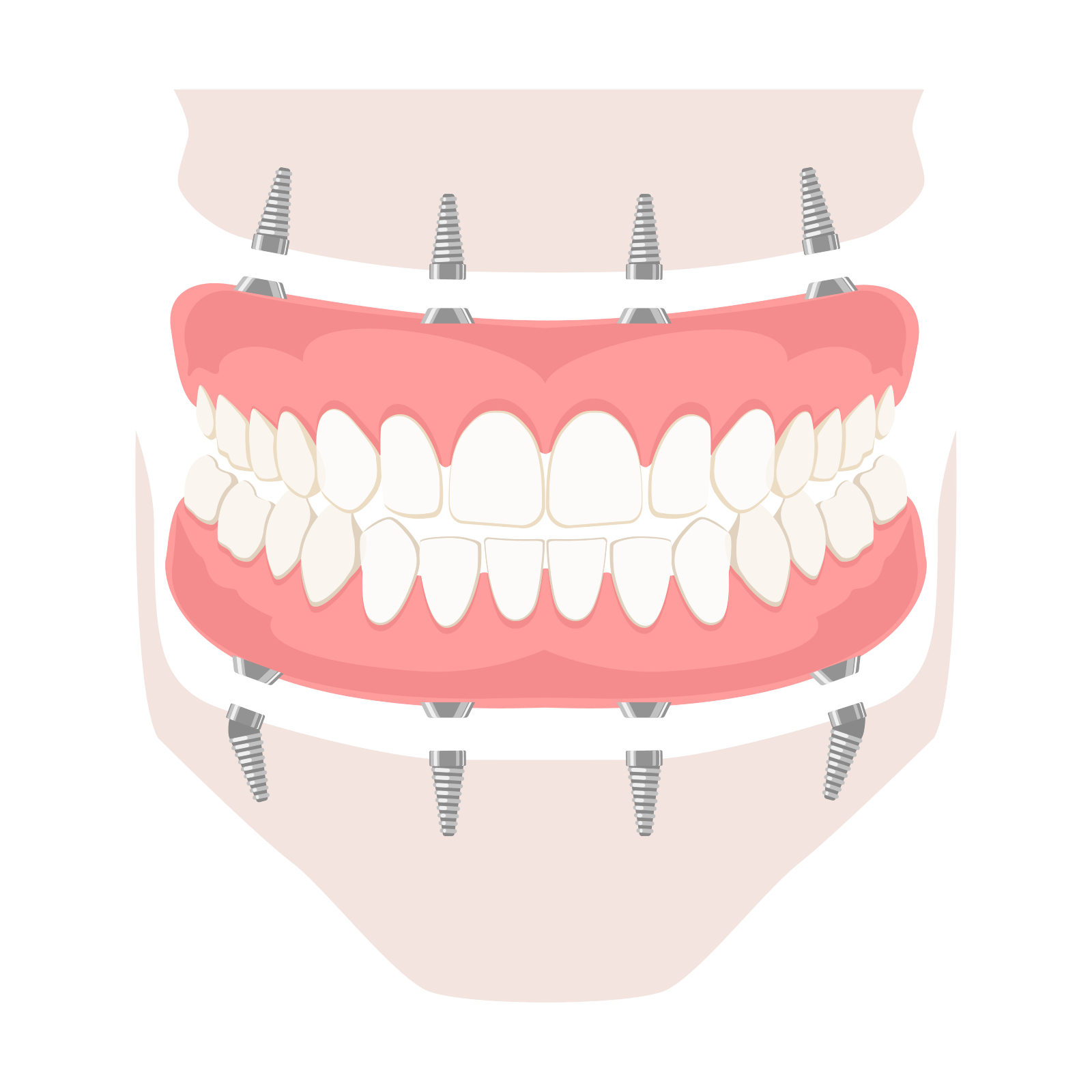 Removable denture on implants