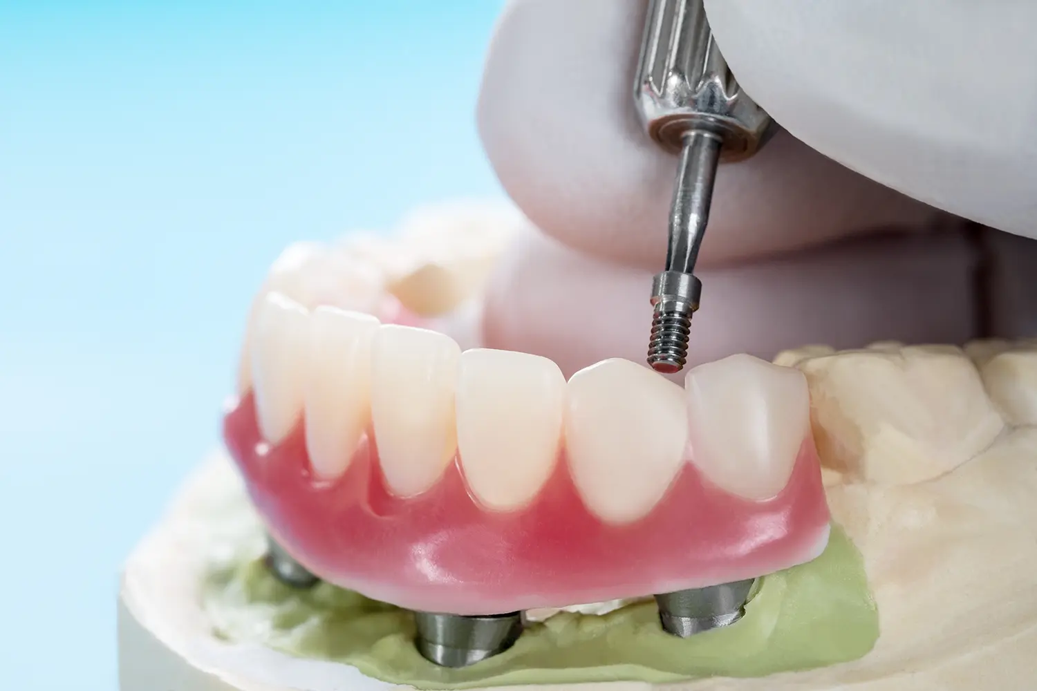full arch dental implants in conover