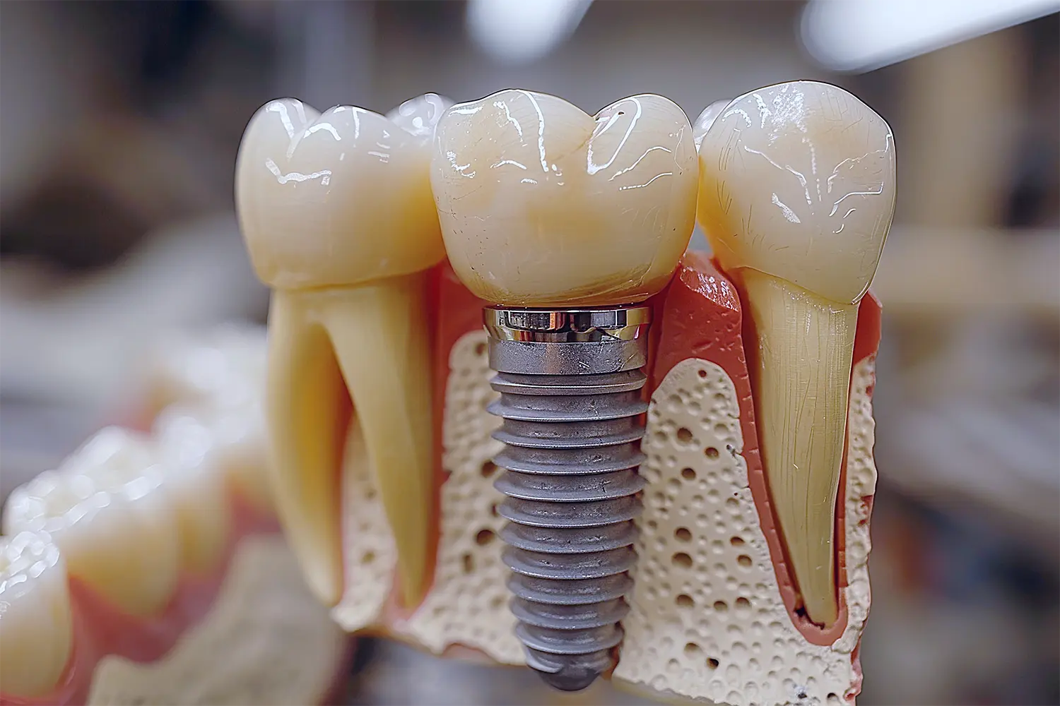 conover dental implants