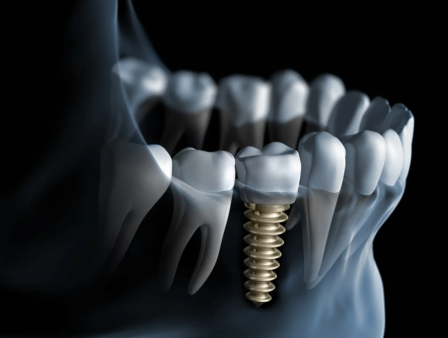 dental implants in conover nc