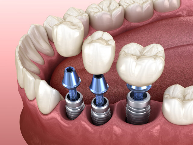 Dental implantation, teeth with implant screw, 3d illustration
