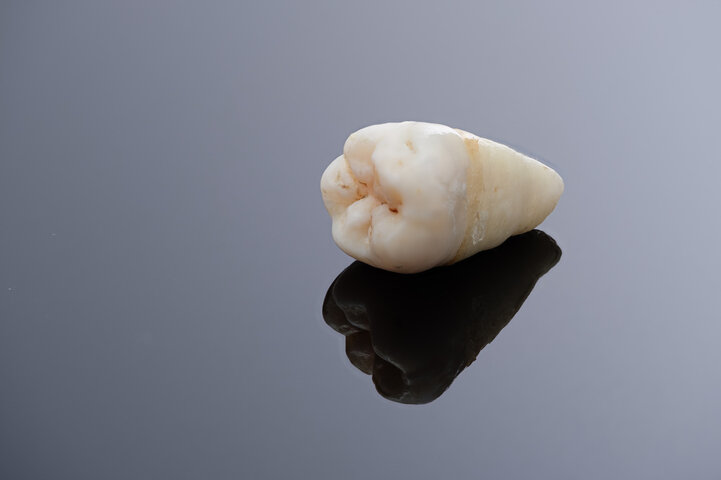 wisdom teeth removal conover